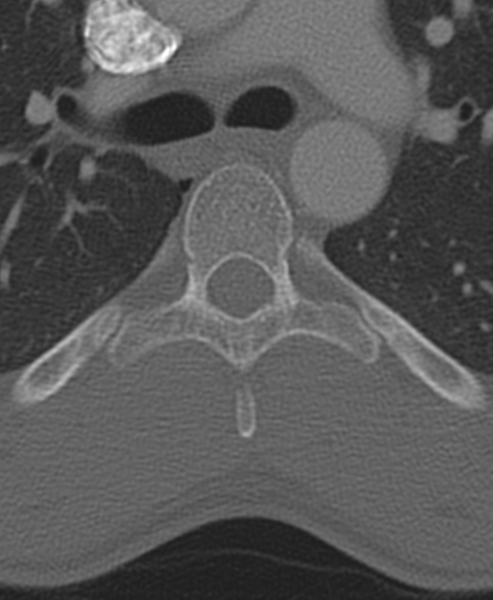 File:Normal CT thoracic spine (Radiopaedia 40181-42688 Axial bone window 38).png