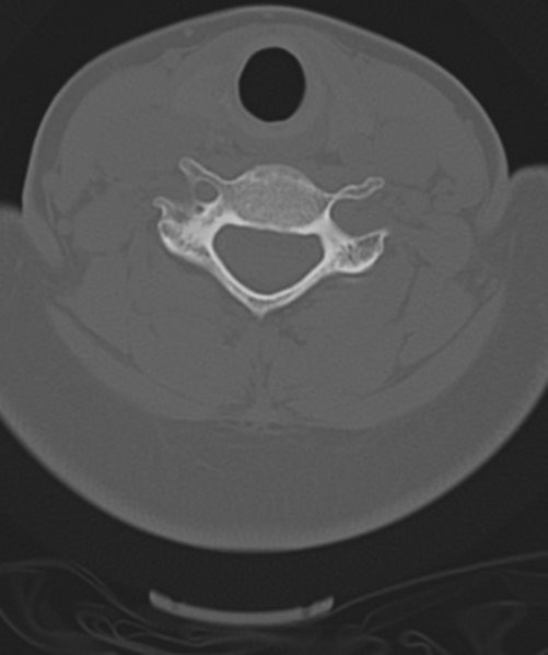 File:Normal cervical spine MRI (including Dixon) (Radiopaedia 42762-45926 Axial bone window 38).png