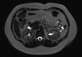 Normal liver MRI with Gadolinium (Radiopaedia 58913-66163 E 15).jpg