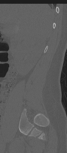 File:Normal lumbosacral CT (Radiopaedia 37923-39867 Sagittal bone window 84).png