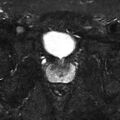 Normal prostate (MRI) (Radiopaedia 29986-30535 Axial STIR 8).jpg