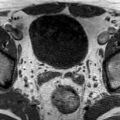 Normal prostate (MRI) (Radiopaedia 29986-30535 Axial T1 24).jpg