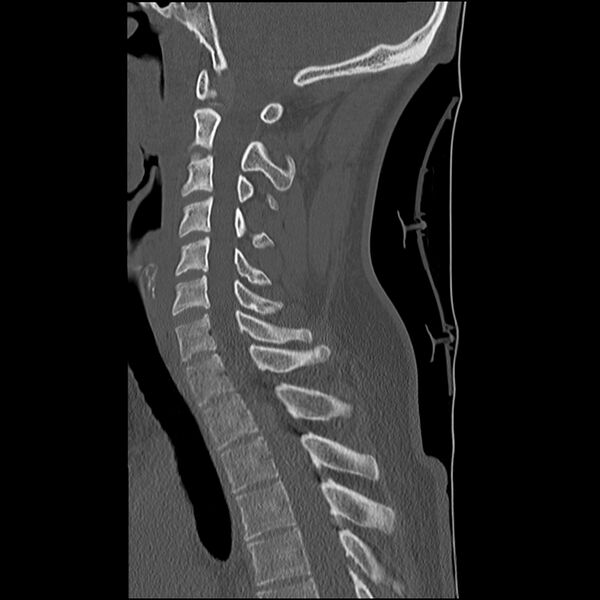 File:Normal trauma spine imaging (Radiopaedia 31753-32686 Sagittal bone window 23).jpg