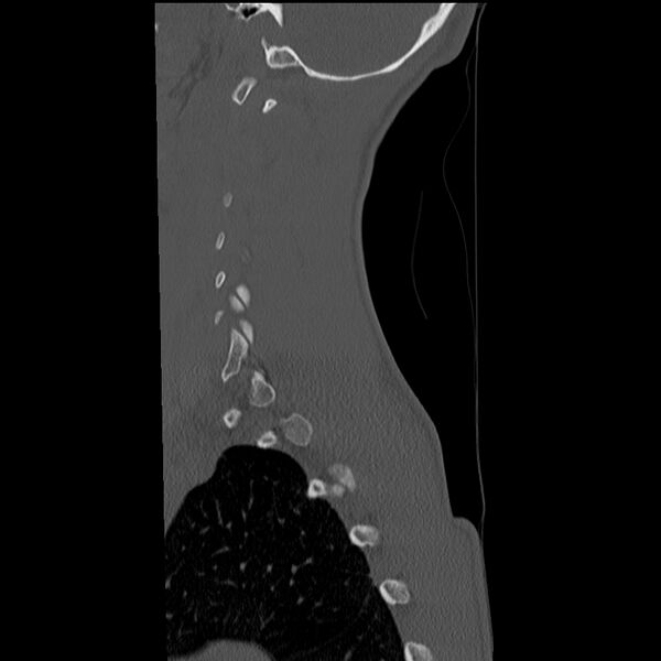 File:Normal trauma spine imaging (age 16) (Radiopaedia 45335-49358 Sagittal bone window 34).jpg