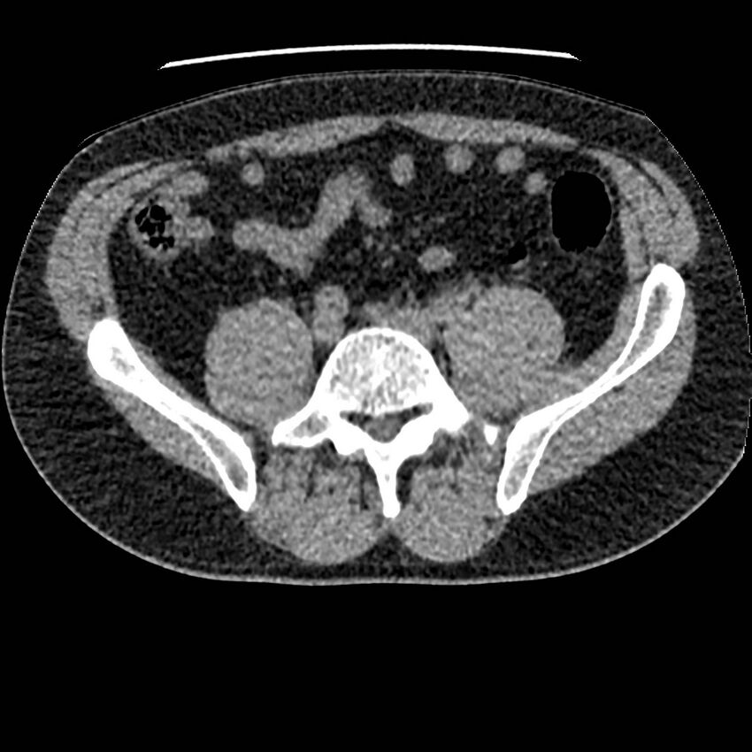 Obstructing ureteric calculus and ureteric anatomy (Radiopaedia 62730-71042 Axial non-contrast 101).jpg