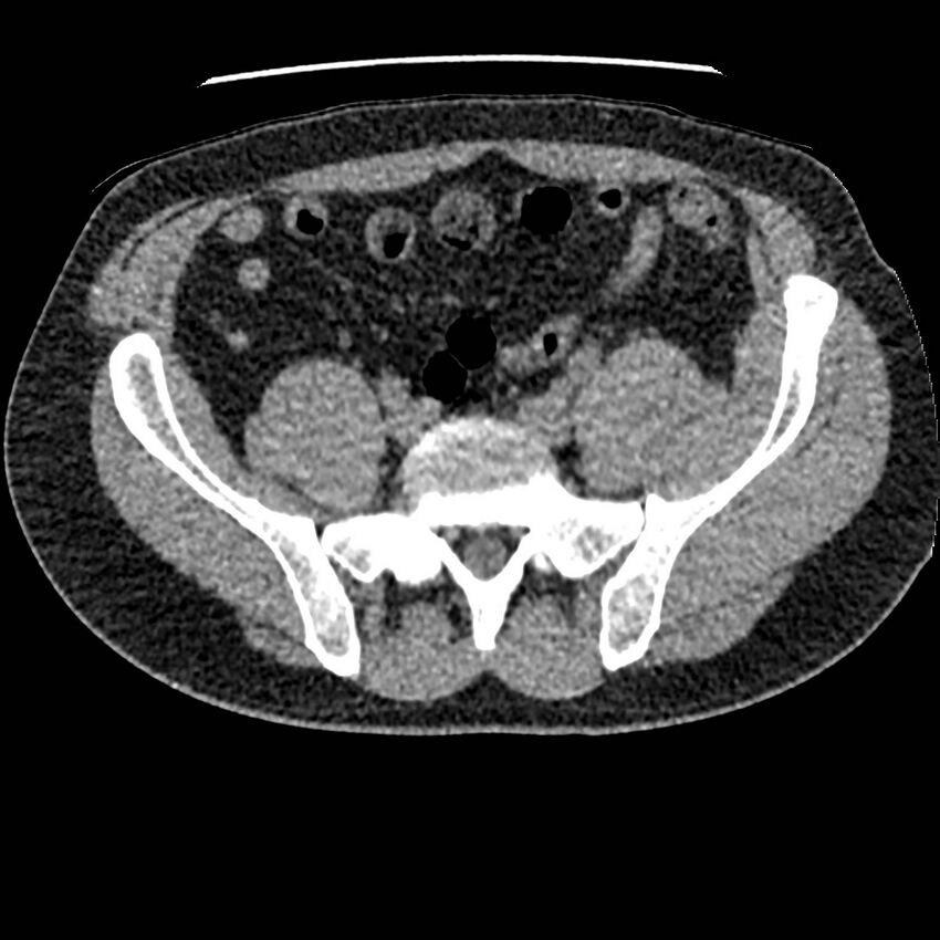 Obstructing ureteric calculus and ureteric anatomy (Radiopaedia 62730-71042 Axial non-contrast 111).jpg