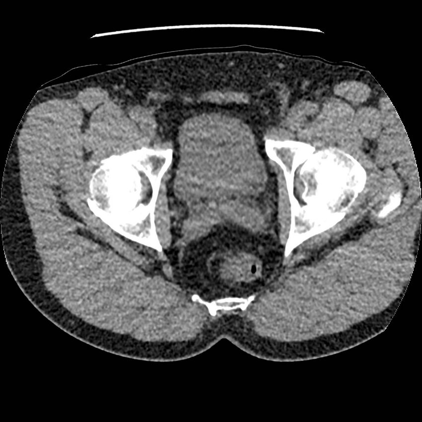 Obstructing ureteric calculus and ureteric anatomy (Radiopaedia 62730-71042 Axial non-contrast 161).jpg