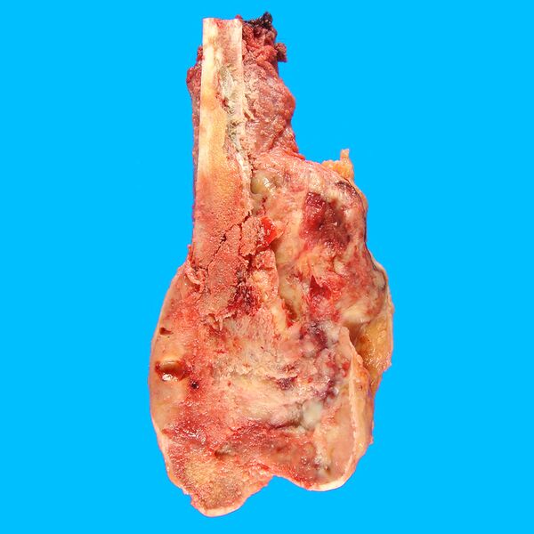 File:Osteosarcoma - distal femur (gross pathology) (Radiopaedia 7621).jpg