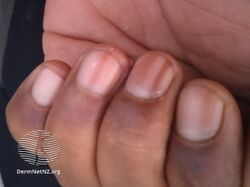 Racial melanonychia (multiple longitudinal bands of several nails)
