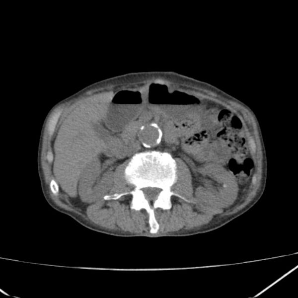 File:Abdominal aortic aneurysm (Radiopaedia 23703-23856 Axial non-contrast 22).jpg