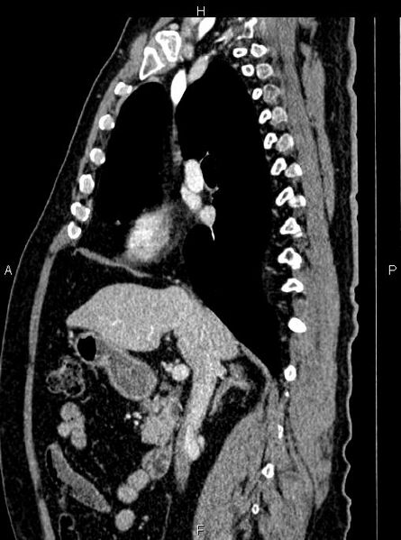 File:Abdominal aortic aneurysm (Radiopaedia 83094-97462 Sagittal renal cortical phase 53).jpg