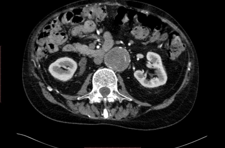 Abdominal aortic interposition tube graft and aneurysm thrombosis (Radiopaedia 71438-81857 Axial C+ arterial phase 66).jpg