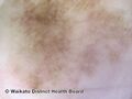 Acral lentiginous melanoma dermoscopy (DermNet NZ alm-dermoscopy-4).jpg