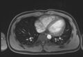 Active right ventricular cardiac sarcoidosis (Radiopaedia 55596-62100 Axial Post contrast Dixon 51).jpg