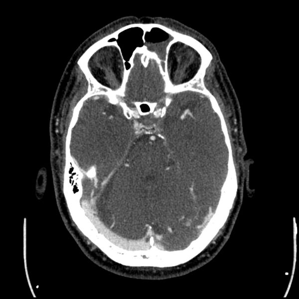File:Acute A3 occlusion with ACA ischemic penumbra (CT perfusion) (Radiopaedia 72036-82527 Axial C+ arterial phase thins 118).jpg