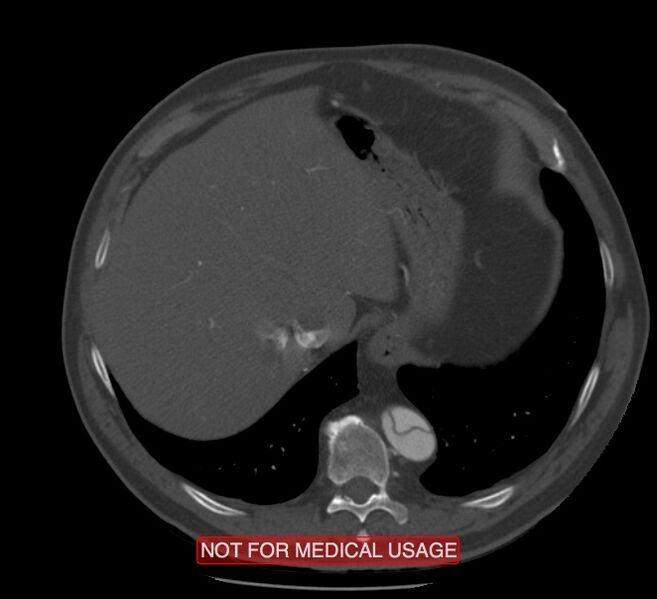 File:Acute aortic dissection - Stanford type A (Radiopaedia 40661-43285 Axial C+ arterial phase 67).jpg