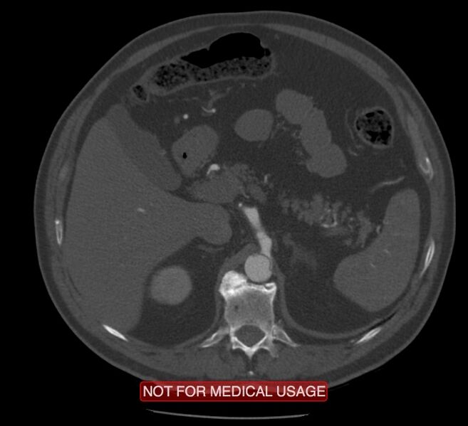 File:Acute aortic dissection - Stanford type A (Radiopaedia 40661-43285 Axial C+ arterial phase 90).jpg