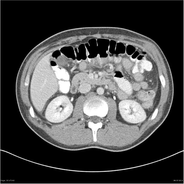 File:Acute appendicitis (Radiopaedia 25364-25615 B 23).jpg