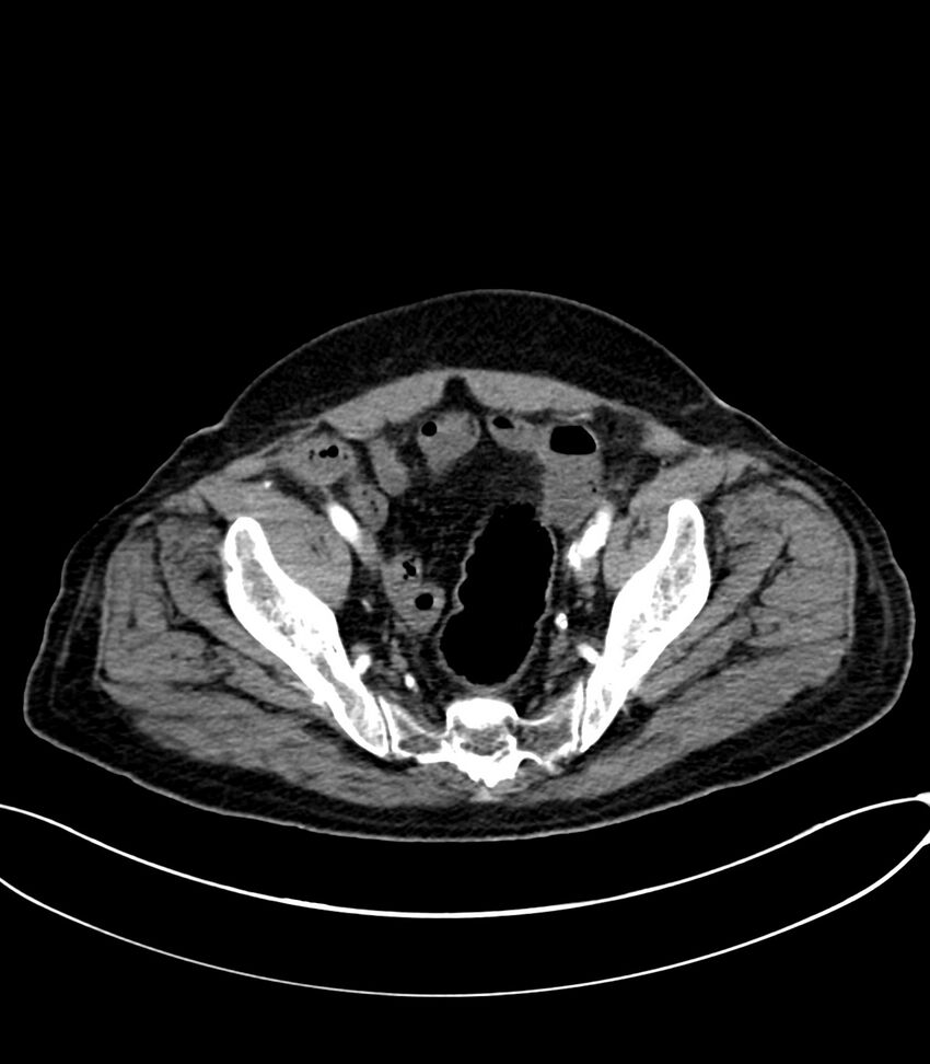 Acute arterial mesenteric ischemia (Radiopaedia 78238-90828 Axial C+ arterial phase 120).jpg