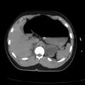 Acute aspiration pneumonitis (Radiopaedia 33605-34703 Axial non-contrast 84).jpg