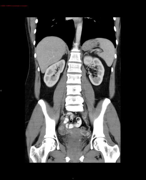 File:Acute gastritis (Radiopaedia 21043-20975 Coronal C+ portal venous phase 8).jpg