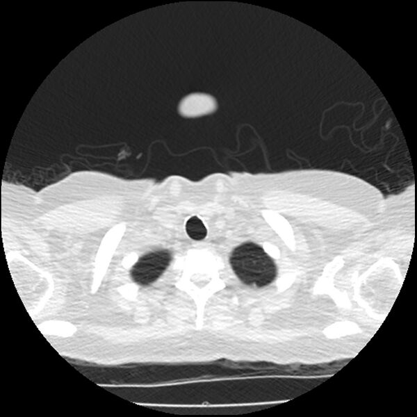 File:Acute interstitial pneumonitis (Radiopaedia 45404-49444 Axial lung window 5).jpg