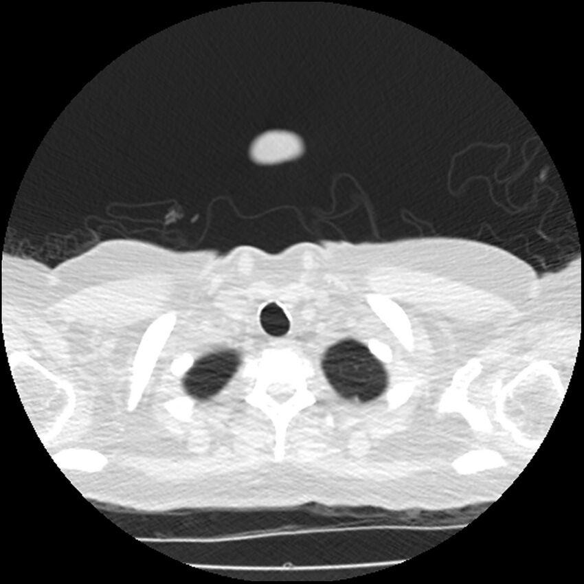 Acute interstitial pneumonitis (Radiopaedia 45404-49444 Axial lung window 5).jpg