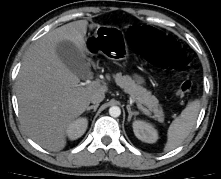 File:Acute mesenteric ischemia - superior mesenteric artery thrombosis (Radiopaedia 73947-84776 Axial C+ arterial phase 7).jpg