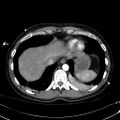 Acute myocardial infarction in CT (Radiopaedia 39947-42415 Axial C+ arterial phase 117).jpg