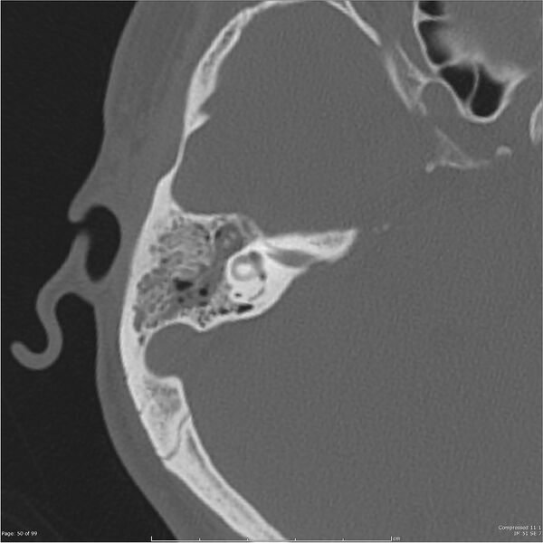 File:Acute otomastoiditis (Radiopaedia 28276-28512 Axial PTB bone window reformat 30).jpg