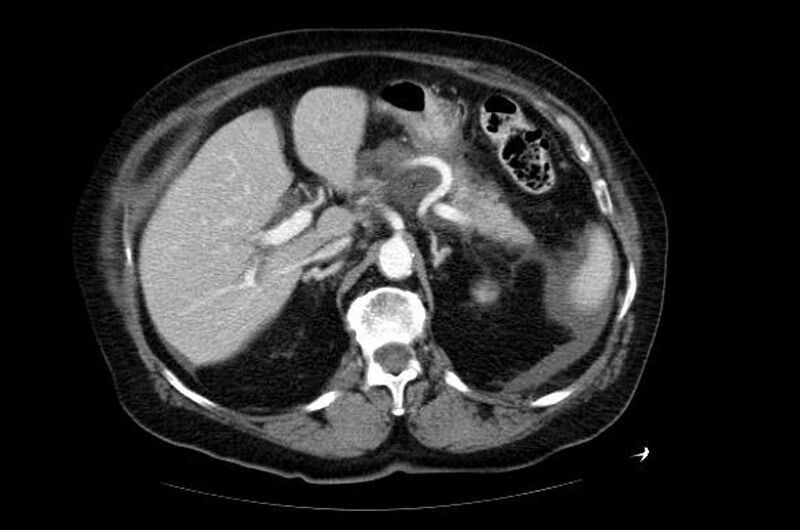 File:Acute pancreatitis (Radiopaedia 11163-11528 Axial 1).jpg