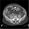 Acute pancreatitis (Radiopaedia 19135-19116 Axial non-contrast 44).jpg