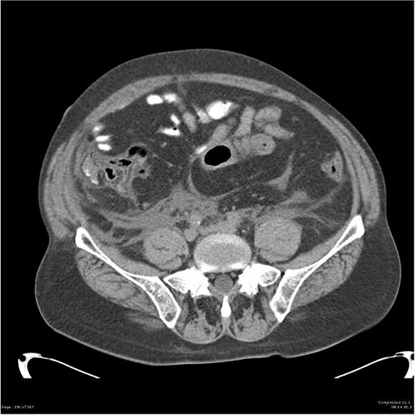 File:Acute pancreatitis (Radiopaedia 19135-19116 Axial non-contrast 44).jpg
