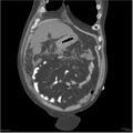 Acute pancreatitis (Radiopaedia 19135-19116 Coronal non-contrast 5).jpg