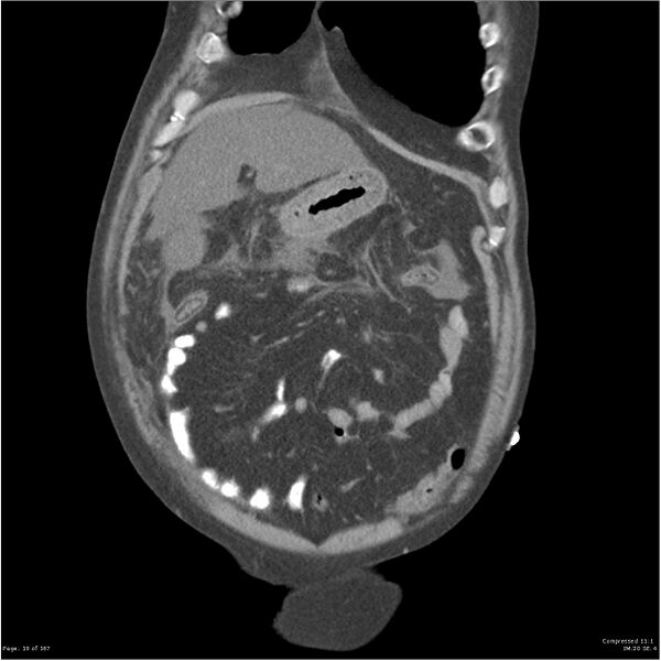 File:Acute pancreatitis (Radiopaedia 19135-19116 Coronal non-contrast 5).jpg