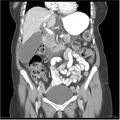 Acute pancreatitis (Radiopaedia 19136-19117 Coronal C+ portal venous phase 16).jpg