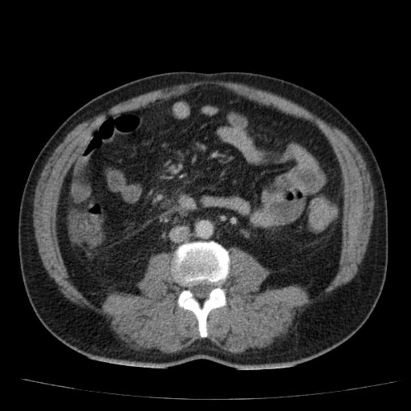 File:Acute pancreatitis (Radiopaedia 26663-26813 Axial C+ portal venous phase 50).jpg