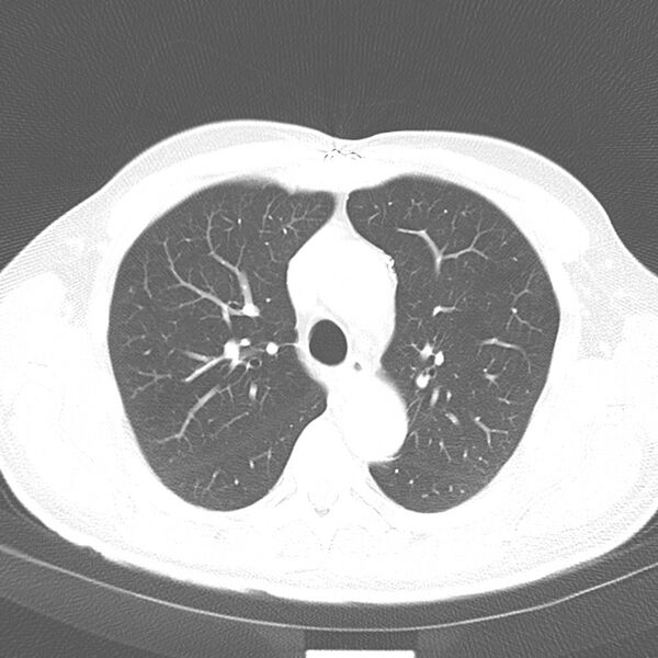File:Acute pulmonary embolism (Radiopaedia 81677-95570 Axial lung window 14).jpg