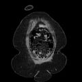 Acute pyelonephritis (Radiopaedia 25657-25837 Coronal renal parenchymal phase 17).jpg