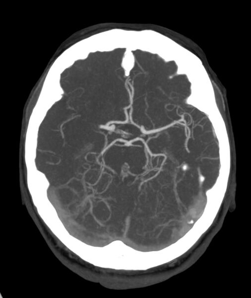 File:Acute right MCA M1 occlusion (Radiopaedia 62268-70454 Axial Phase 1 18).jpg
