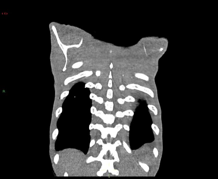 File:Acute right lung abscess (Radiopaedia 34806-36258 Coronal C+ arterial phase 3).jpg