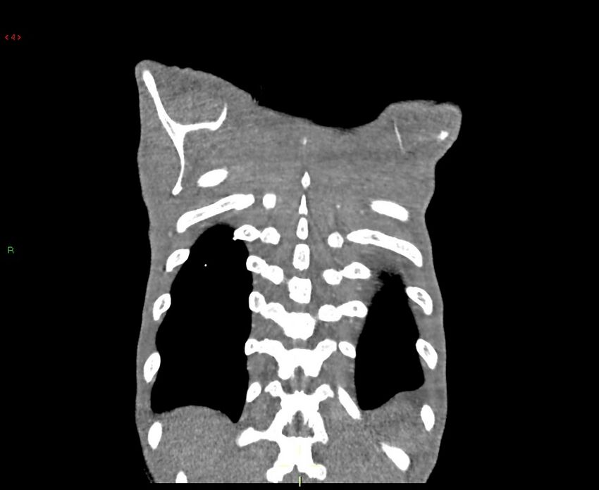 Acute right lung abscess (Radiopaedia 34806-36258 Coronal C+ arterial phase 3).jpg
