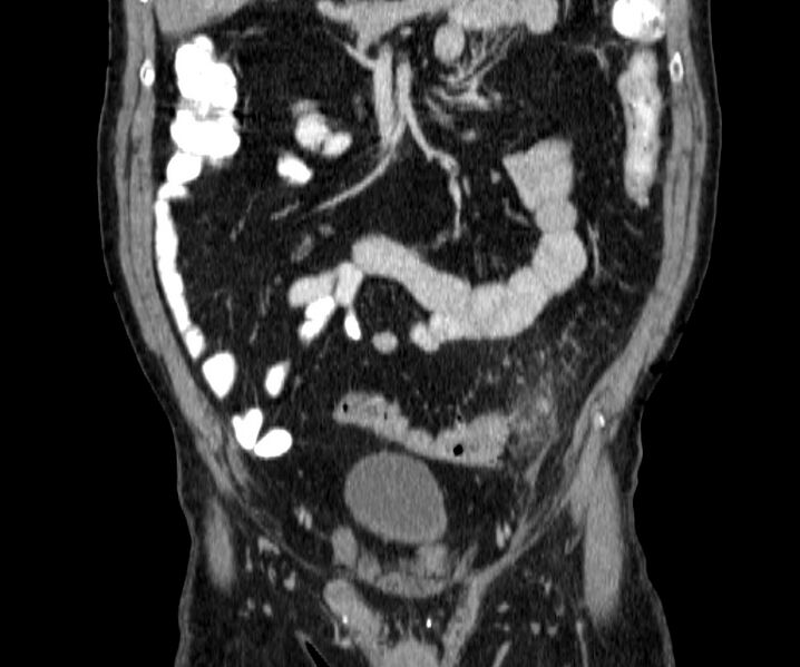 File:Acute sigmoid colon diverticulitis (Radiopaedia 55507-61976 Coronal C+ portal venous phase 45).jpg