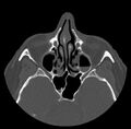 Acute sinusitis (Radiopaedia 23161-23215 Axial bone window 35).jpg