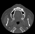 Acute sinusitis (Radiopaedia 23161-23215 Axial bone window 7).jpg