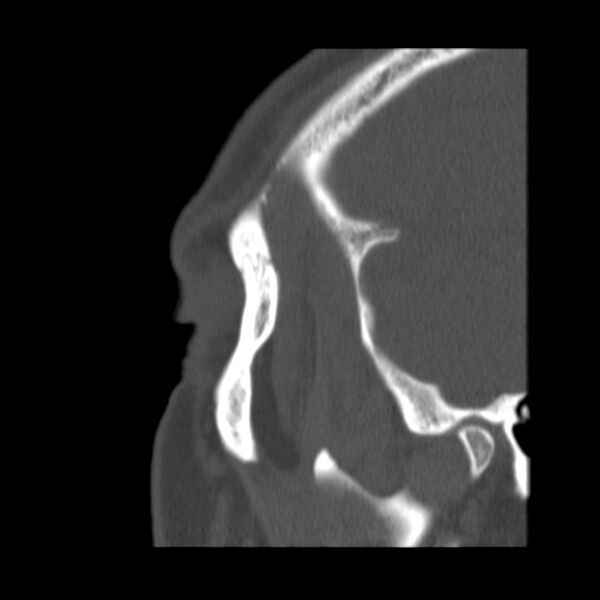 File:Acute sinusitis (Radiopaedia 23161-23215 Sagittal bone window 57).jpg