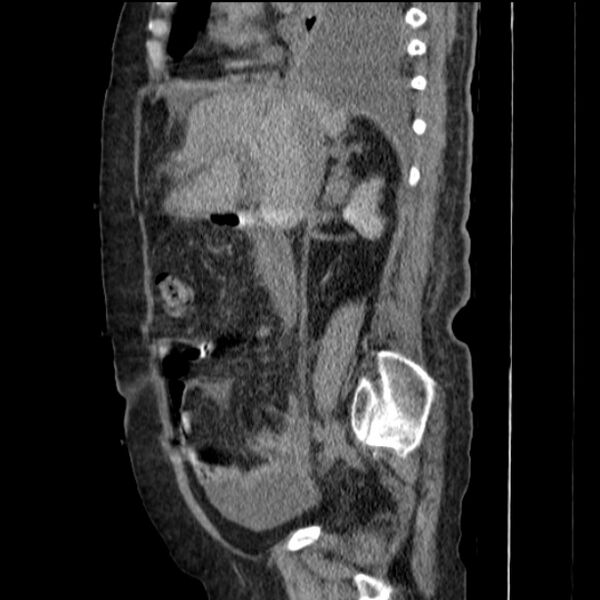 File:Acute tubular necrosis (Radiopaedia 28077-28334 Sagittal non-contrast 36).jpg