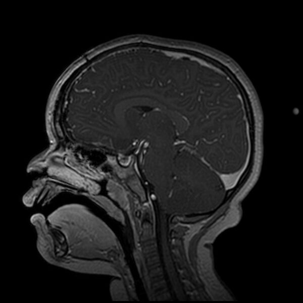 File:Adamantinomatous craniopharyngioma (Radiopaedia 77407-89529 H 66).jpg