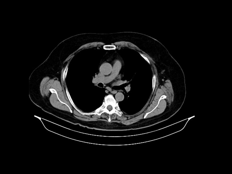File:Adenocarcinoma of pancreas with hepatic metastasis (Radiopaedia 64332-73122 Axial non-contrast 2).jpg