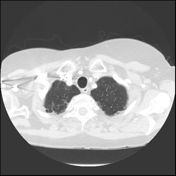 File:Adenocarcinoma of the lung (Radiopaedia 41015-43755 Axial lung window 14).jpg